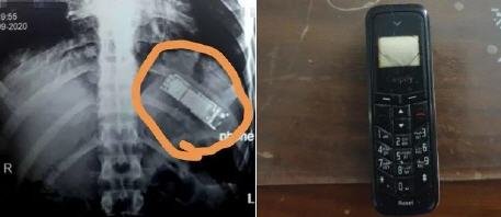 حادثة غريبة.. استخراج هاتف كان قد ابتلعه منذ 7 أشهر!