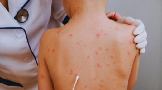 وزارة الصحة : نتابع عن كثب الوضع الوبائي لمرض جدري القردة.. ورصدنا 5 حالات هينة منذ يونيو 2022