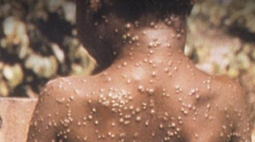 منظمة الصحة العالمية: تسجيل 780 إصابة بجدري القردة في 27 دولة