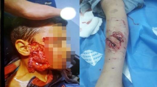 “وجدة : بيتبول” ينهش وجه طفل ذو 9 سنوات..كان يلعب رفقة أصدقائه