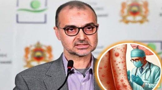 اليوبي..الإصابة بـ”بوحمرون”تمتد لتشمل جميع الفئات العمرية