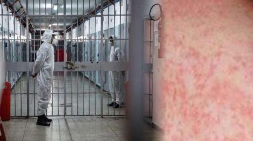 رصد 41 حالة إصابة بداء الحصبة بعدد من المؤسسات السجنية.