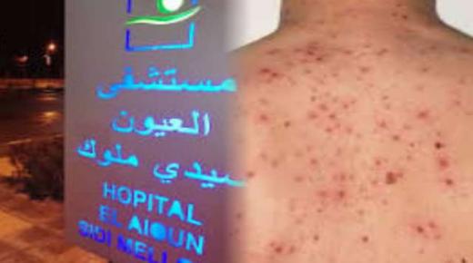 مستشفى القرب بالعيون سيدي ملوك يستقبل حالة إصابة بداء بوحمرون